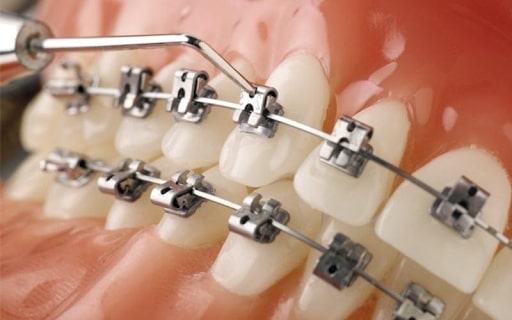 Niềng răng mắc cài tự khóa là sự kết hợp giữa tính thẩm mỹ và hiệu quả điều chỉnh răng