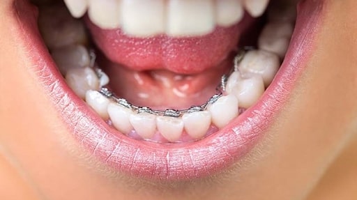 Niềng răng mặt lưỡi là lựa chọn cho những người muốn giữ vẻ ngoại hình tự nhiên