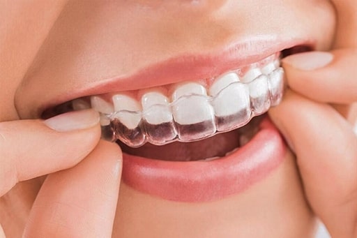 Niềng răng không mắc cài như Invisalign là một phương pháp hiện đại, thẩm mỹ