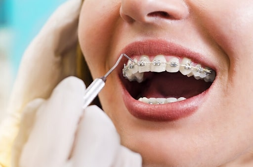 Chọn một địa chỉ nha khoa uy tín có kinh nghiệm là rất quan trọng trong quá trình niềng răng