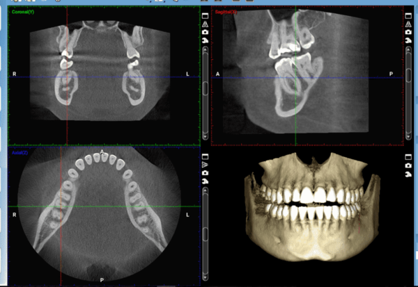 Chụp CT scan và lấy dấu răng 3D chính xác