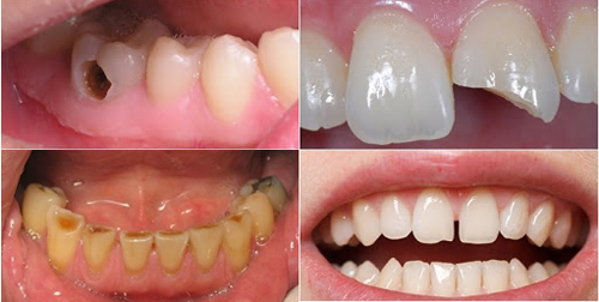 Có bọc sứ cho răng bị bể lớn được không?