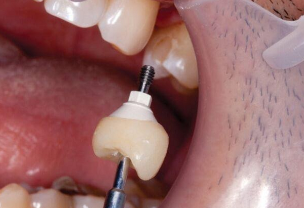 Tình trạng răng Implant bị lung lay không còn xa lạ gì và nó khiến cho nhiều người lo sợ