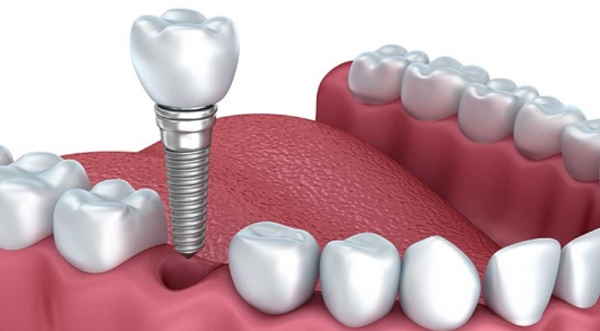 Lựa chọn nha khoa uy tín sẽ giảm thiểu tối đa nguy cơ răng Implant lung lay, gãy rụng