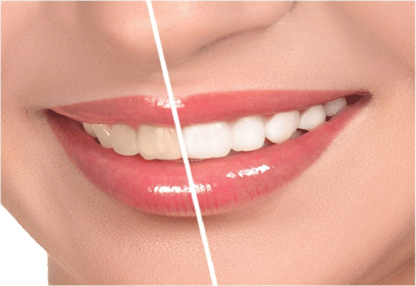 Tẩy trắng răng là biện pháp làm trắng răng được nhiều người ưa chuộng