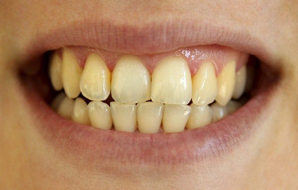Tẩy trắng răng là phương pháp phổ biến để cải thiện màu sắc răng