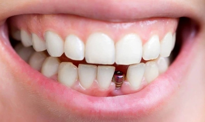 Trồng răng Implant là một quy trình phục hình răng 