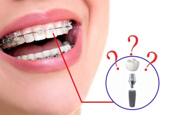 Trồng răng Implant có niềng răng dược không là vấn đề được nhiều người quan tâm
