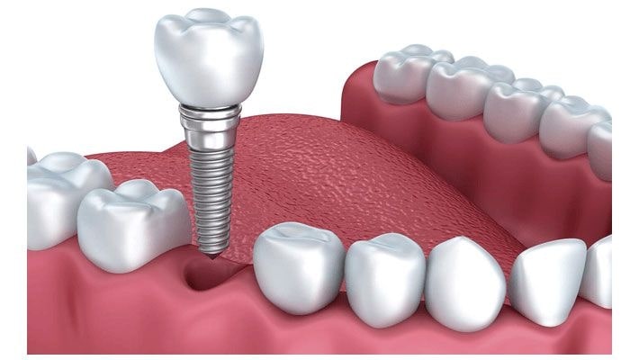Trồng răng Implant giúp mang đến sự tự tin và thoải mái trong cuộc sống hàng ngày