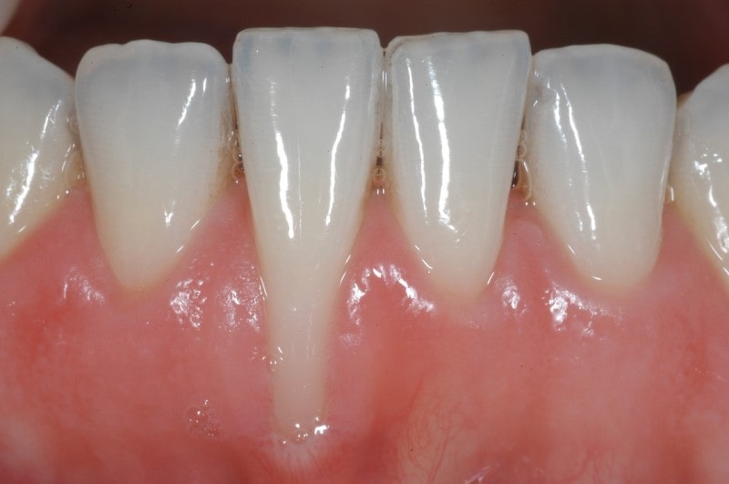 Răng implant giúp phục hình răng đã mất một cách toàn diện và lâu dài