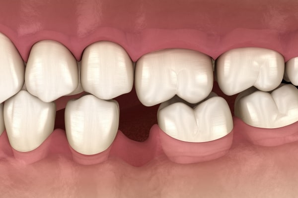 Răng implant giúp ngăn chặn tình trạng tiêu xương và tụt lợi sau khi mất răng