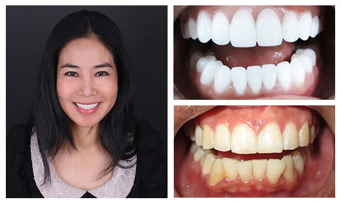 trước và sau quá trình trồng răng implant 1