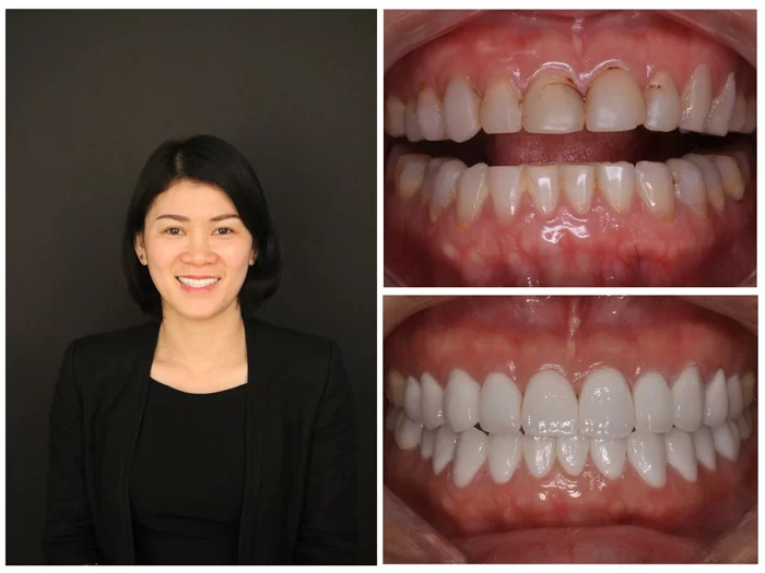 Hình ảnh Trước và sau quá trình trồng răng implant tại Emedic Dental