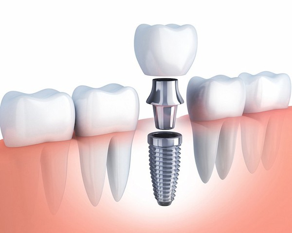 Các loại trụ Implant xuất xứ từ Đức luôn được giới chuyên môn đánh giá cao