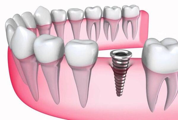 Tuổi thọ của các trụ Implant Đức có thể kéo dài đến trọn đời