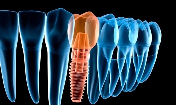 Tìm hiểu các loại Implant Đức phổ biến nhất