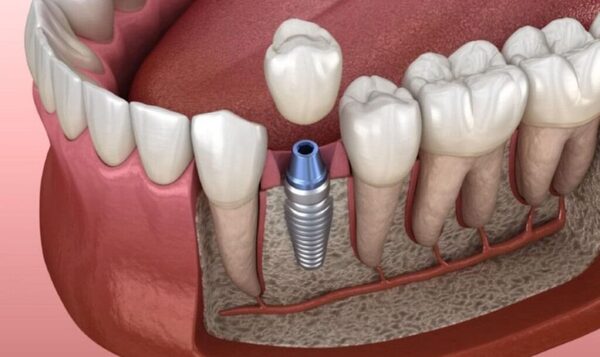 Bạn cần quan tâm nhiều yếu tố trước khi lựa chọn loại trụ Implant