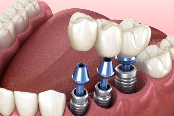 Các loại trụ Implant hiện nay đều có chế độ bảo hành tốt