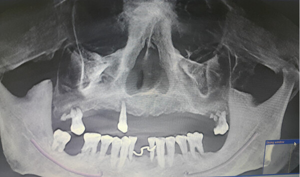 Trụ Implant được sử dụng để thay thế chân răng đã mất