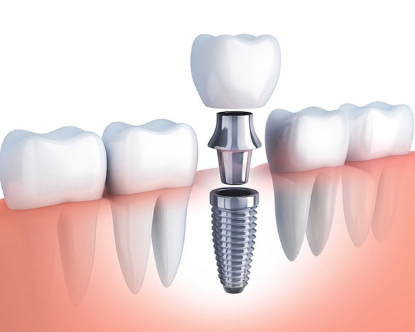 Trụ Implant Osstem đảm bảo thay thế chân răng hiệu quả