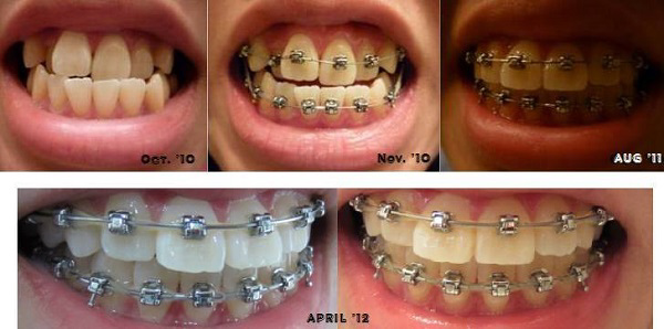 Thay đổi khuôn mặt trước và sau khi niềng răng cho trường hợp răng móm