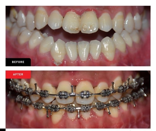 Thay đổi khuôn mặt trước và sau khi niềng răng trong trường hợp điều trị khớp cắn hở
