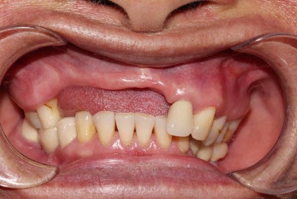 Mất nhiều răng hoặc toàn bộ dãy răng có thể xảy ra do nhiều nguyên nhân