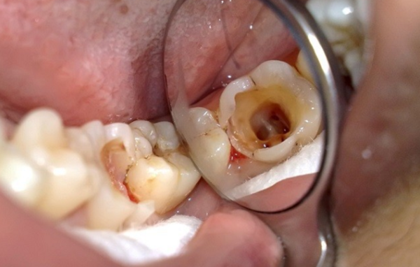 Bọc răng sứ giúp bảo vệ răng bị viêm hoặc hư tủy