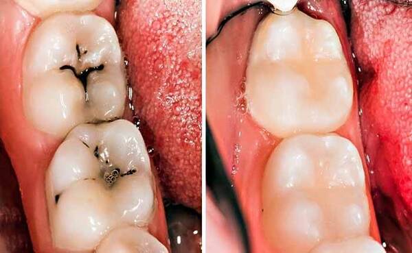Răng sâu nặng cần được bọc sứ để bảo vệ răng
