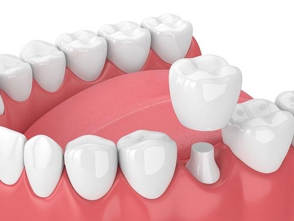 Kỹ thuật chuyên môn bác sĩ cao sẽ giúp tăng tuổi thọ của răng