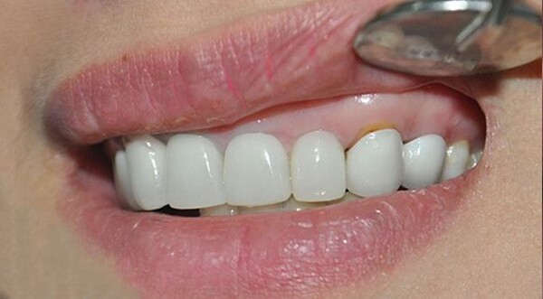 Răng sứ bị hở cũng là dấu hiệu cho thấy răng sứ của bạn hết hạn