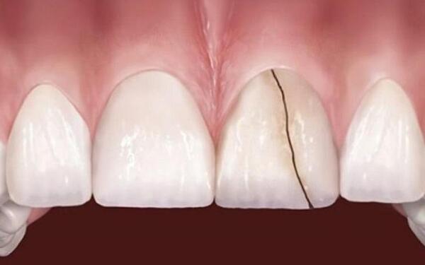 Răng dễ bị sứt mẻ sau khi hết hạn