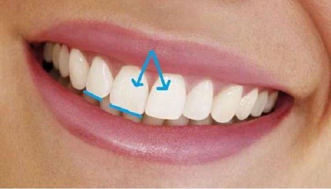 Đây là chiếc răng có vị trí nổi bật nhất trên cung hàm
