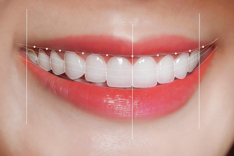 Điều chỉnh tình trạng răng đẹp, cân đối sẽ khiến nụ cười của bạn thêm phần tự tin