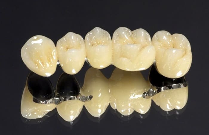 Răng sứ Crom Cobalt loại răng sứ kim loại