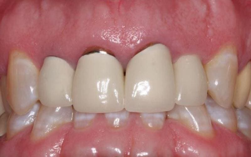 Nếu như bạn lựa chọn nha khoa uy tín thì làm răng sứ rất dễ bị hư hỏng