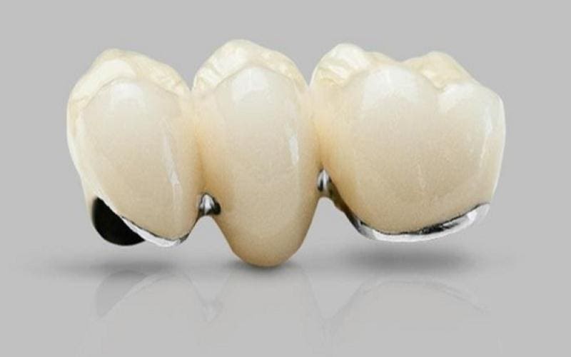 Đây là loại răng sứ được cấu tạo từ chất liệu cao cấp