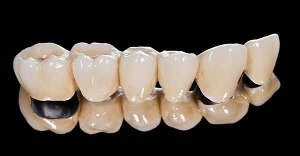 Răng sứ Ceramco mang nhiều ưu điểm vượt trội