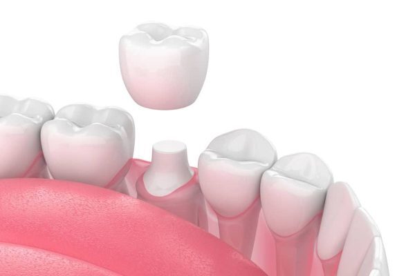 Có 2 loại răng sứ Ceramill khác nhau