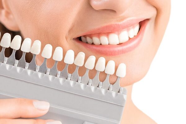 Giá của răng Cercon còn phụ thuộc vào nha khoa mà bạn điều trị