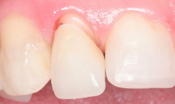 Dấu hiệu răng sứ bị hở là như thế nào?