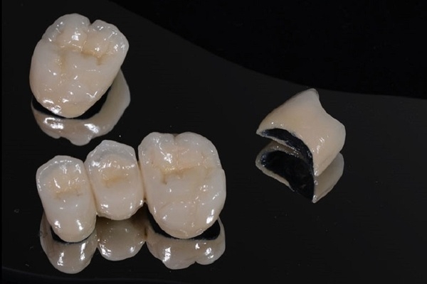 Bọc răng sứ titan là như thế nào?