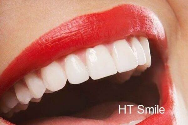 Chi phí làm răng HT Smile là bao nhiêu?