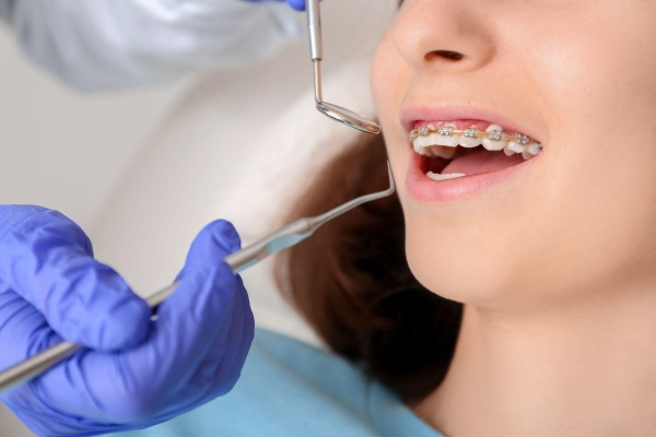 Nhiều nguyên nhân dẫn đến tình trạng niềng răng xong vẫn xấu