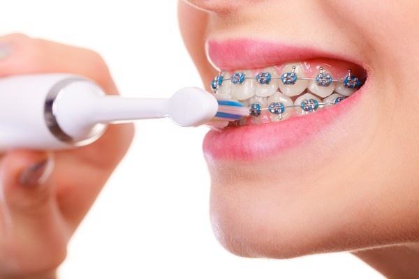 Vệ sinh răng miệng không đúng là một trong những nguyên nhân niềng răng xong vẫn xấu