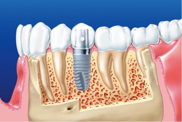 Có nhiều biến chứng và tác hại có thể xảy ra khi trồng răng implant