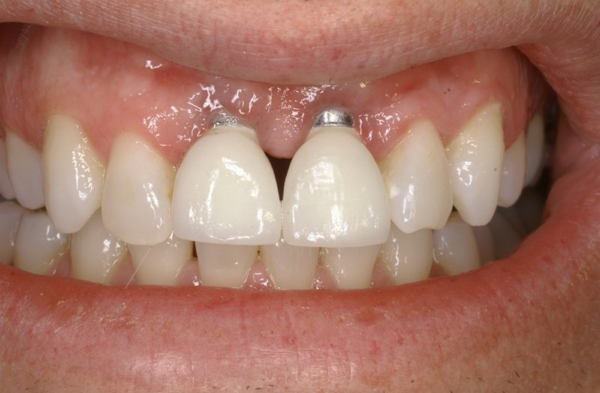 Cấy ghép Implant tức thì giúp phục hình lại răng, khôi phục thẩm mỹ khuôn mặt