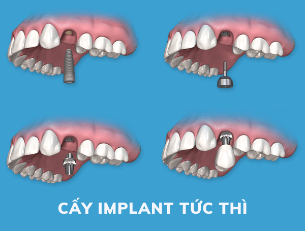 Lý tưởng nhất là nên cấy ghép implant ngay sau khi vừa nhổ răng