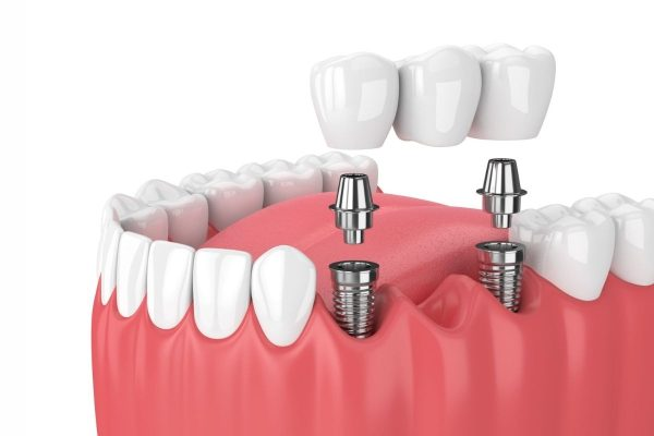 Thời gian để trồng răng implant thường mất khoảng 4-8 tháng