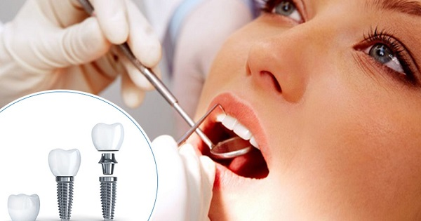 Quy trình trồng răng implant không đau chuẩn Quốc tế như thế nào?